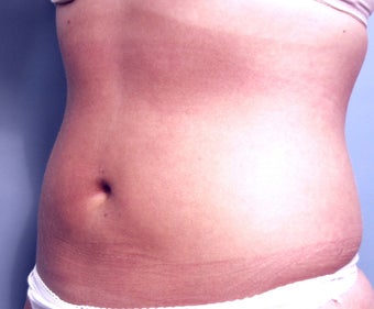 Slim Lipo after 137507