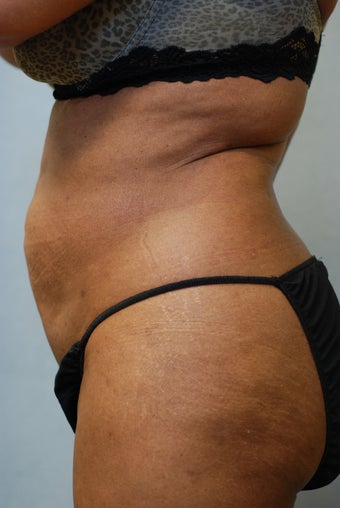 SmartLipo 356692