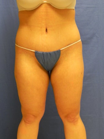 Body Lift after 460723