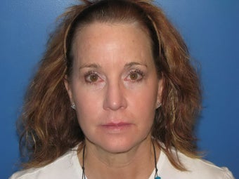Microlaser Peel, Profractional Laser, and Broad Band Light treament after 526333
