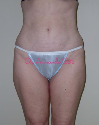 Lipoabdominoplasty after 141563