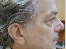 CO2 Fractional Laser after 459873