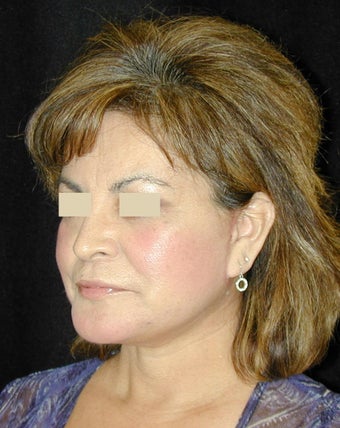 Facelift / Necklift after 103844
