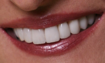 Porcelain Veneers after 213080