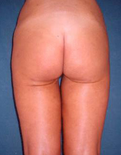 Butt Lift after 230706