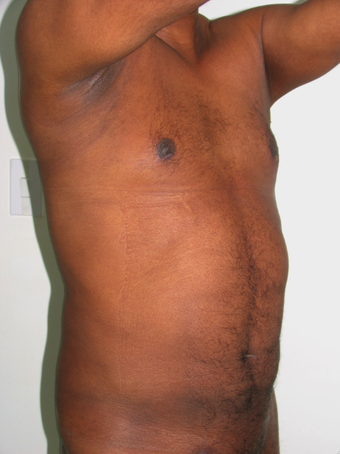 Tummy Liposuction after 229658