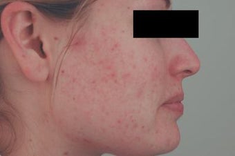 Laser Acne Scar Removal before 82979