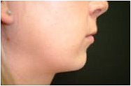 Chin Implant before 302192