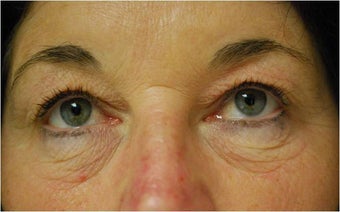 upper and lower Laser Blepharoplasty-Eyelid Surgery before 341305