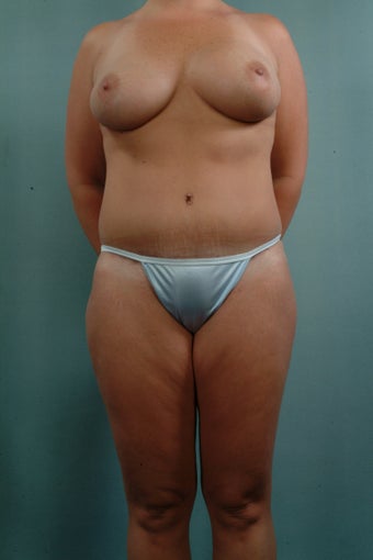 Breast Augmentation/Tummy Tuck/Liposuction after 241581