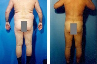 Liposuction before 636170