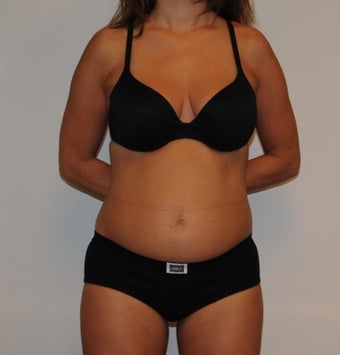 Liposuction before 195874