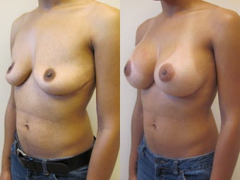 Breast augmentation after 220769