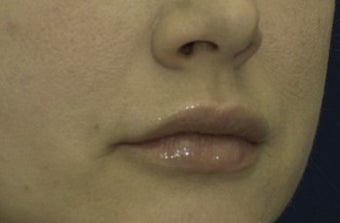 Lip Lift 606639