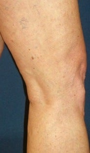 Sclerotherapy after 370426