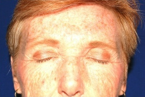 Facelift, Intense Pulsed Light 132103