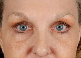 Browlift and Upper/Lower Eyelid Surgery after 253601