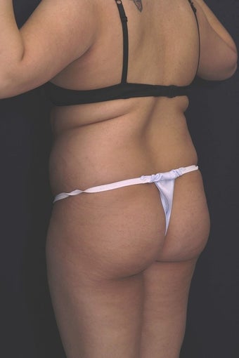 Fat injections to buttocks for Brazilian Butt Lift before 101299