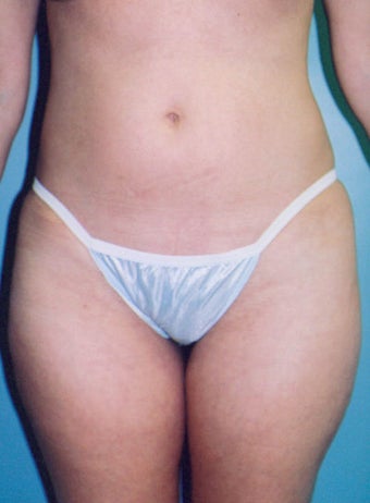 Mini-Tummy Tuck with Liposuction before 265962