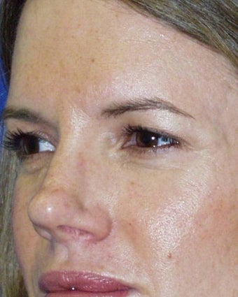 Rhinoplasty and Brow Lift before 142527