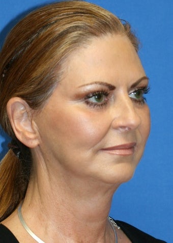 Facelift, Fat Transfer, Upper Bleph, Lower Eyelid Skin Pinch 424181