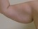 Slim Lipo on the arms before 548953