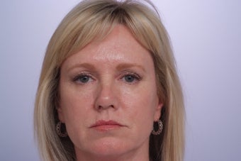 Endoscopic Forehead Lift before 250431