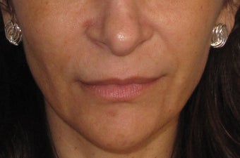 Restylane before 326036