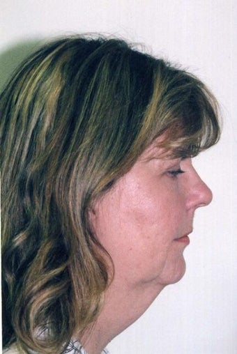 Neck Lift before 215152