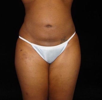 Liposuction Abdomen, Waist, Flanks and Dorsal Roll after 203518