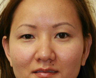 Double Eyelid procedure before 378907