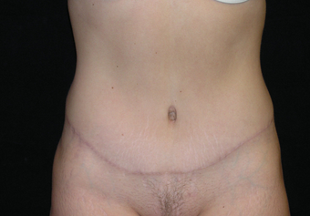 Abdominoplasty after 476707