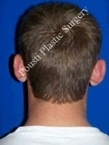 Ear Surgery (Otoplasty) before 616578
