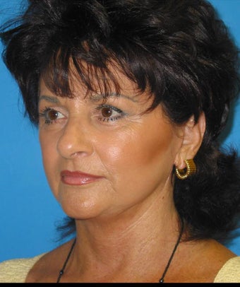Facelift, 35% TCA peel after 84415