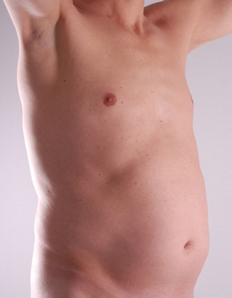 Tummy Liposuction before 229669