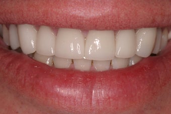 porcelain crowns 330389
