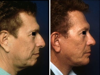 Rhinoplasty, chin implant and facelift before 139116