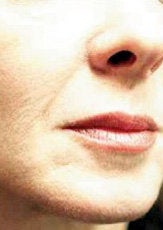 Facial Fillers after 341053