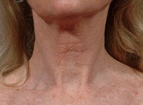 Laser resurfacing-Fraxel Re:store after 459021