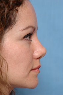 Revision Rhinoplasty before 581092