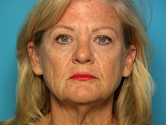 Facelift and Blepharoplasty before 141133