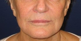 Restylane injection into lips and nasolabial folds before 109944
