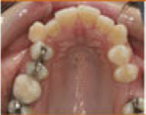 Damon System Braces 477293