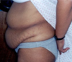 Tummy Tuck before 234036