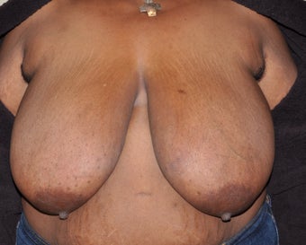 Breast Reduction before 287439