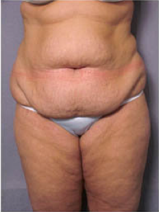Adominoplasty before 428195