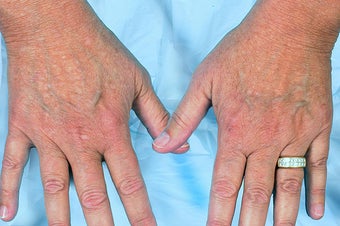 Radiesse for Hand Rejuvenation before 114166