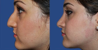 Rhinoplasty before 633424