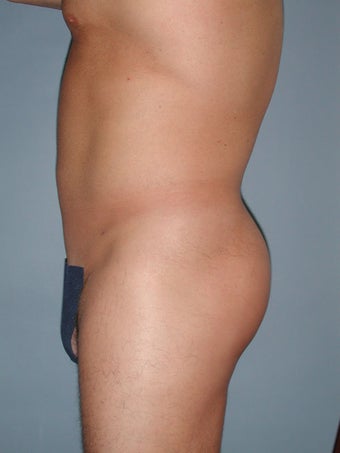 Liposuction 581412