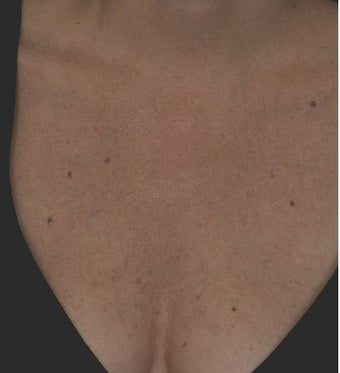 Laser treatment for sun damage after 123342